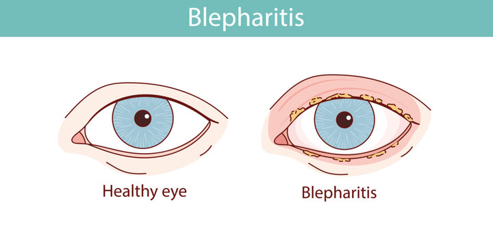 Blepharitis of the eye vector anatomical illustration