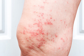 Skin diseases, skin allergies in women, itchy rash, dermatitis, skin texture of patients