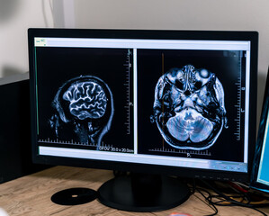 Brain MRI scan on monitor. MRI scans show detailed images of a human brain from different angles,...