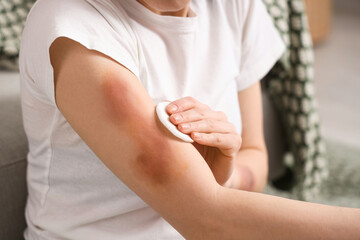 Beautiful young woman treating her bruised arms with cotton pad at home, closeup