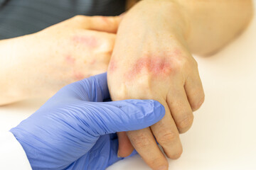 Atopic Dermatitis. Allergy to chemicals, Cracked and sore skin, Red, itchy hands with blisters seen...