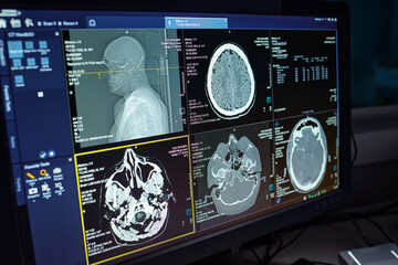 Multiple brain scans displayed on a high-resolution monitor in medical setting with detailed analysis