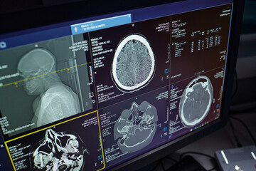 Images display various brain scans on computer screen in modern radiology lab, showing detailed...