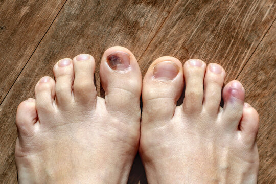 Close-up bruised nail of the big toe and broken toe. Violet toenail and violet toe. Injured foot.