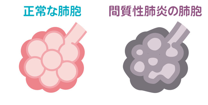 正常な肺胞と間質性肺炎の肺胞