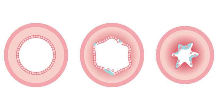 健康な人の気道と喘息の人の気道