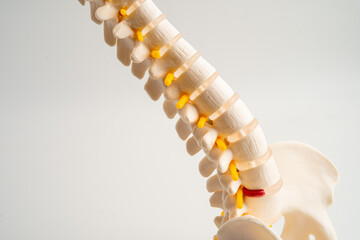 Lumbar spine displaced herniated disc fragment, spinal nerve and bone. Model for treatment medical...