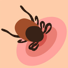 Encephalitis tick biting human skin causing lyme disease. Wild or domestic tick, skin parasites. House dust mite allergy.Healthcare illustration.