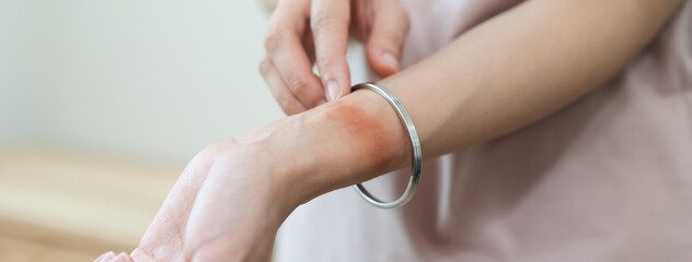 red rash on the skin from allergy, jewelry. Close-up red rash on the wrist.