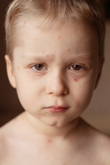 Close-up of a child's face with rashes. Chicken pox in children. Sad child