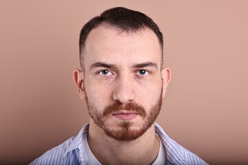 Obraz premium Baldness problem. Man with receding hairline on dark beige background