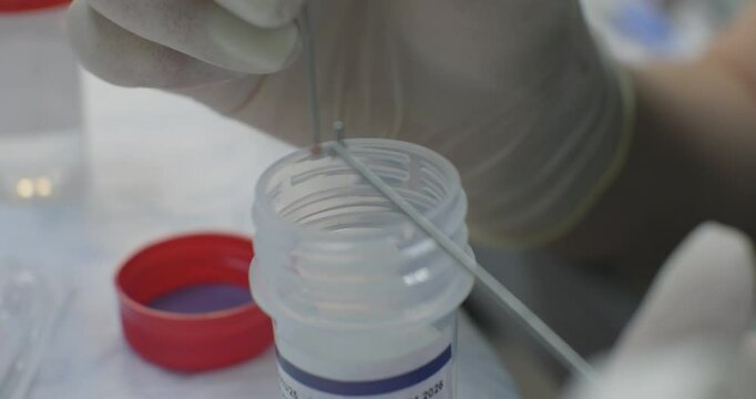 A doctor places a biopsy sample taken during an endoscopy in formalin. Close-up of a doctor placing a piece of tissue taken during an endoscopy for histological examination.