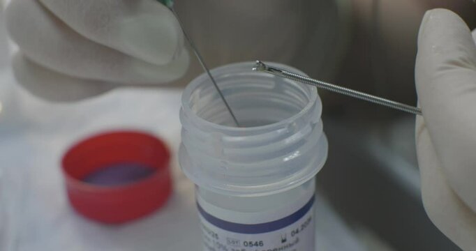Taking a biopsy during an endoscopic examination. The doctor places a small tissue sample for histological examination in a jar with formalin. Endoscopic biopsy.