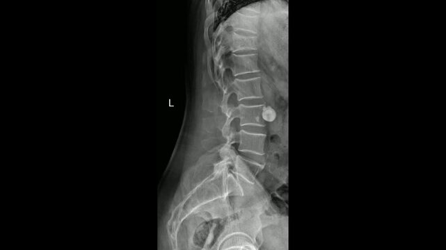Lumbar Spine Lateral X-Ray Demonstrating Vertebral Alignment and Disc Space
