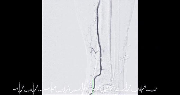 Femoral Angiogram of femoral artery showing femoral artery vessel isolated on white background for diagnosis atherosclerosis.	