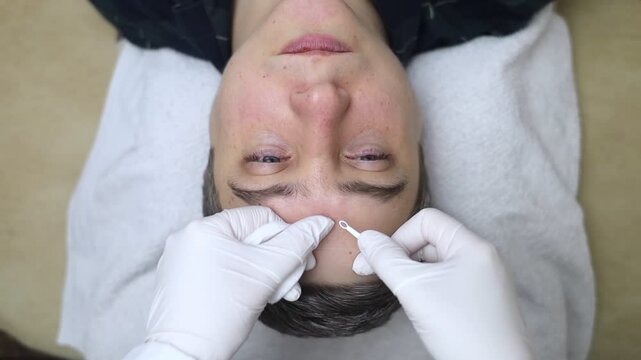 Man undergoing facial cleansing and blackhead removal. Beautician using comedone extractor or uno loop. Professional skin care in a beauty salon