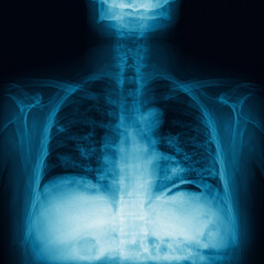 Chest X-ray showing lungs, spine, and ribs with medical imaging detail. Close-up of shoulder joint, injuries of tendons and bones. Medical diagnostics, internal anatomy and health film concept