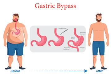 Gastric Bypass A Life Changing Weight Loss Surgery