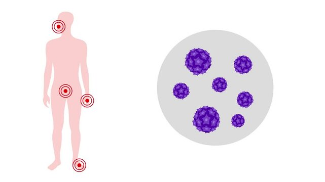 Video animation human papilloma virus in zoom view on human feet. Hpv in human body