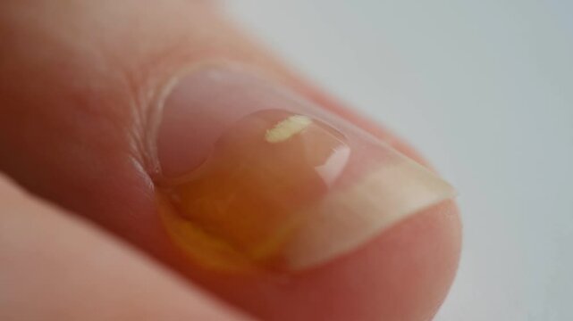 Treatment leukonychia with application cbd oil drop by drop on affected fingernail, close up in slowmotion. Effective treatment options and proactive care strategies to combat appearance leukonychia.