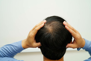 Fototapeta premium Bald head in man, hair loss treatment health problem.