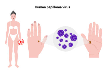 Human papilloma virus on hands. Medical screening illustration in zoom