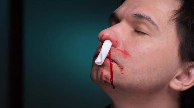 Man suffering from nosebleed holding tissue against nostrils. nosebleed stopped with a tampon