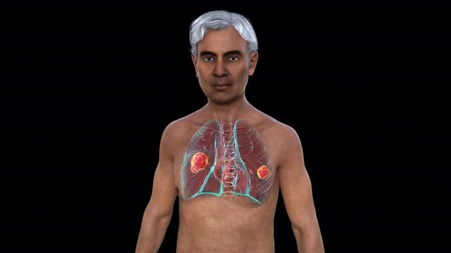 Lung mucormycosis, 3D animation showing fungal infection caused by Mucorales fungi, highlighting multiple irregular lung nodules.