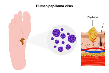 Fototapeta premium Human papillomavirus on feet. Medical screening illustration in zoom