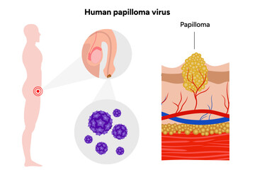 Human papilloma virus on reproductive system. Medical screening illustration in zoom