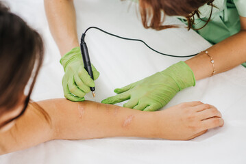 A cosmetologist performs a cosmetic procedure Plasma sublimation to remove scars on a woman's hand
