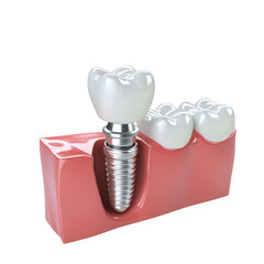 A Dental implant model, showcasing titanium screw and ceramic crowns, representing modern dental restoration techniques. This highlights importance of dental health and aesthetics