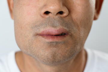 Obraz premium The man has facial swelling due to an allergic reaction to triggers such as insect bites stings.