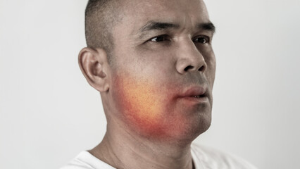 Obraz premium The man has facial swelling due to an allergic reaction to triggers such as insect bites stings.