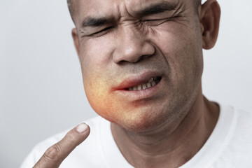 Fototapeta premium The man has facial swelling due to an allergic reaction to triggers such as insect bites stings.