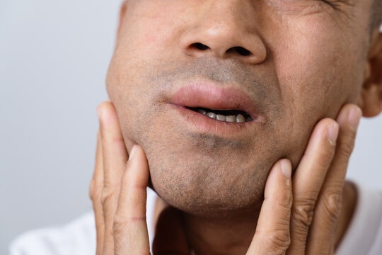 The man has facial swelling due to an allergic reaction to triggers such as insect bites stings.