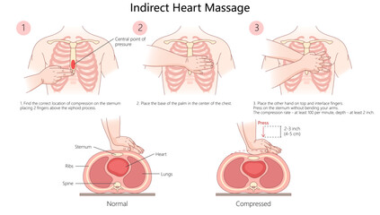 indirect heart massage CPR, showing proper hand placement, compression depth, and technique for effective chest compressions diagram hand drawn vector illustration. Medical science educational