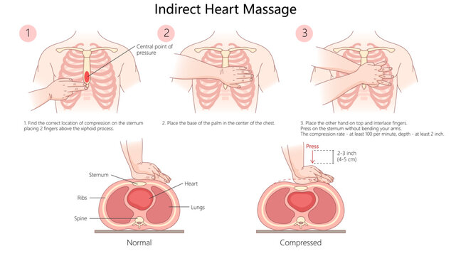 indirect heart massage CPR, showing proper hand placement, compression depth, and technique for effective chest compressions diagram hand drawn vector illustration. Medical science educational