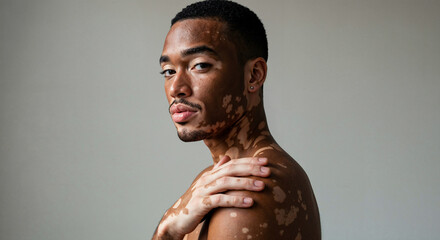 Portrait of person with vitiligo skin condition showing confidence and self-acceptance, Natural studio lighting, Wellness and body positivity concept, Diversity in beauty standards