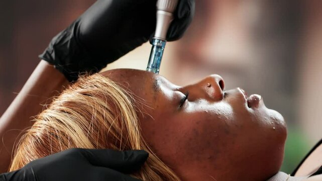 Skin Microneedling In Beauty Clinic