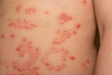 Fototapeta premium Psoriasis skin condition displaying red and scaly patches on the back of an individual
