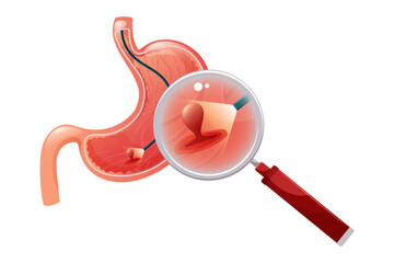 Polyp in stomach. Examination and diagnosis of human internal organ, endoscopy procedure. Vector illustration.