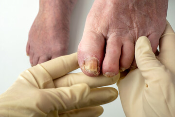 Toenail fungus. A podologist examines toenails affected by a fungal infection. Onycholysis of...
