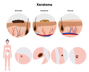 Human keratome and birthmark skin disease microbiology. Medical screening illustration in zoom