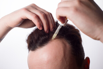 remedy for baldness with a pipette dripping on problem areas in men