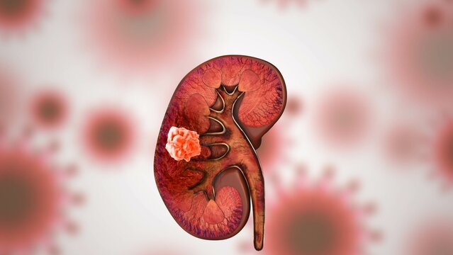 Renal Cell Carcinoma Medical Concept
