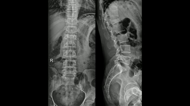 Lumbar Spine AP and Lateral Radiograph Showing Fracture and Vertebral Alignment. Medical image concept and copy space.