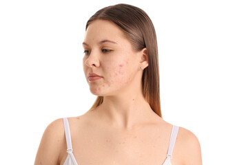 Teenage girl with acne problem on white background, closeup