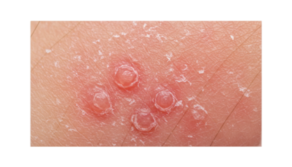 Close-up View of Human Skin Affected by Vesicular Skin Disease Featuring Blisters