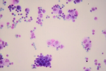 Medical themes: Pleural effusion showing chylothorax caused by B-cell lymphoma